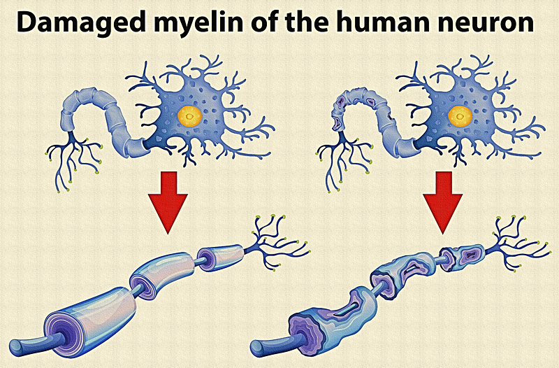 Illustration of the immune response related to multiple sclerosis.